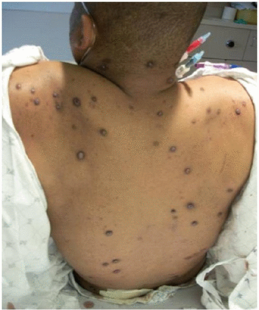 File:Hyperpigmented nodules gif.gif