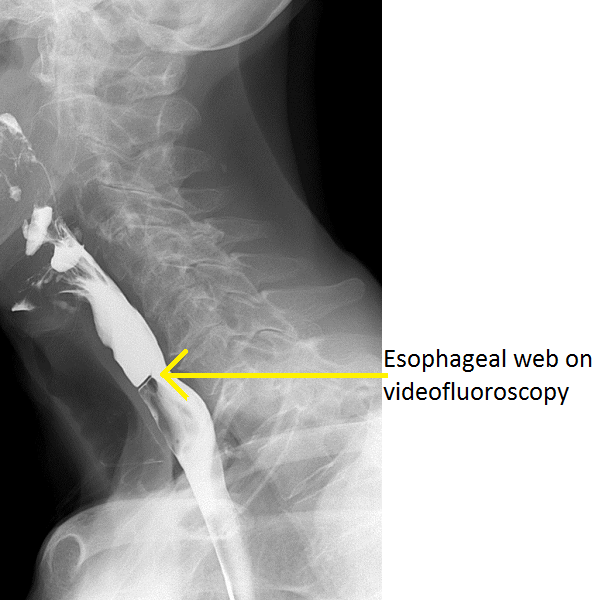 File:Oesophageal-web-1 videofluoroscopy.png