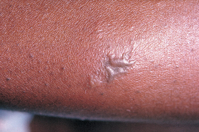 Close-up of a gonococcal lesion on the skin of a patient’s arm.Gonorrhea, caused by Neisseria gonorrhoeae, if left untreated will enter the blood, thereby, spreading throughout the body. As is shown here, such full body dissemination may manifest itself as skin lesions in the form of gray pustules. Adapted from CDC