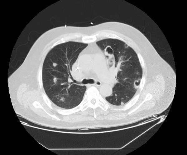 Pulmonary embolism CT - wikidoc