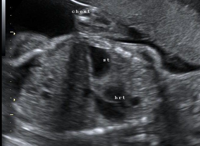 File:Congenital-diaphragmatic-hernia-25.jpg