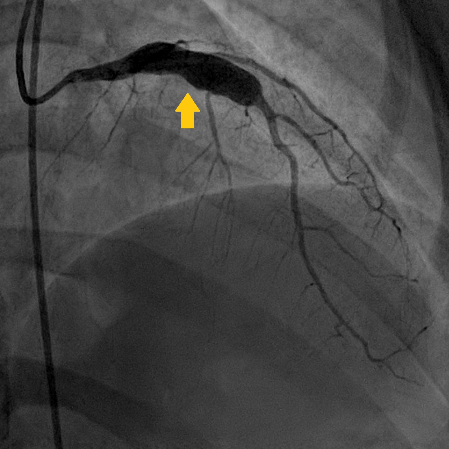 Aneurysm of the left anterior descending artery (arrow).[2]
