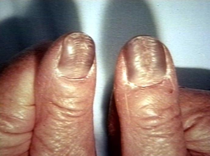 Hydroxyurea Nails; Nail changes associated with Hydroxyurea therapy in a patient with essential thrombocythemia.
