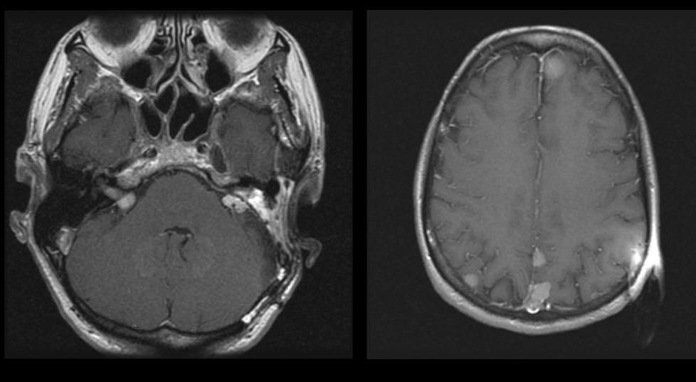 Axial image of a patient with bilateral acoustic neuromas. the patient has NF2. The right image is a higher image in the same patient showing multiple meningiomas
