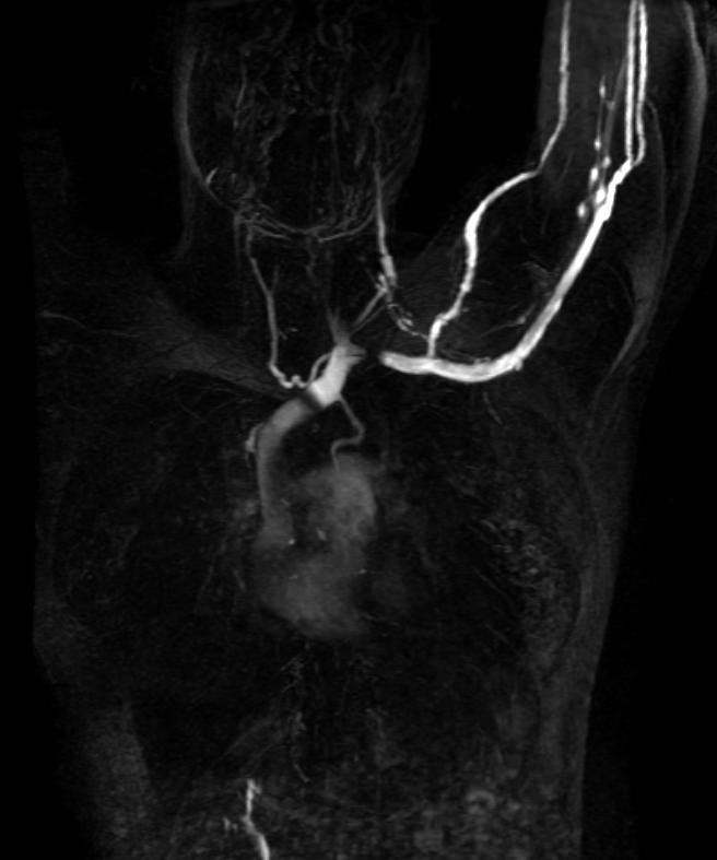 File:Thoracic outlet syndrome MRI 004.jpg