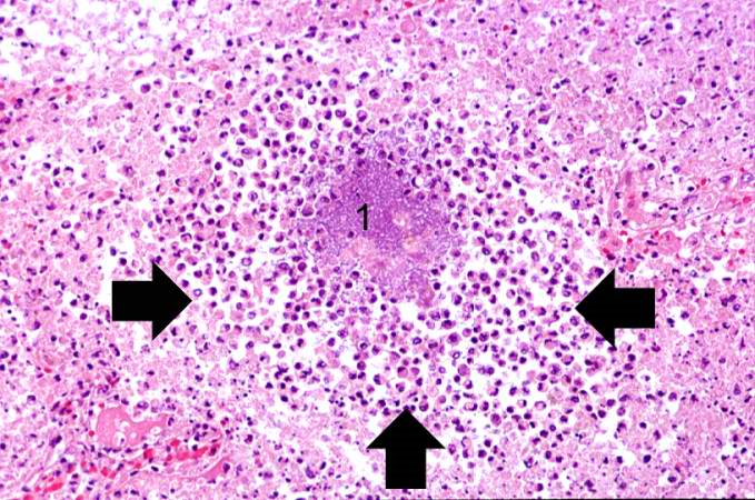 Acute lung abscess abscess full of inflammatory cells (primarily neutrophils) (arrows). There is a bacterial colony in the center of this abscess (1)..
