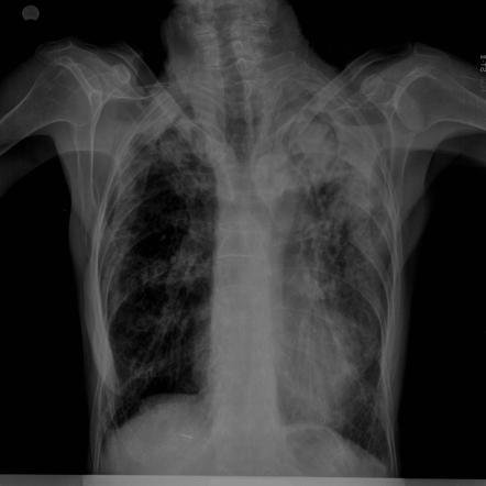 Chest X-ray of a patient demonstrates a rounded soft tissue attenuating masses located inside a cavitary lesion observed at the middle lobe of the right lung