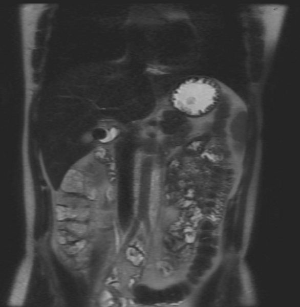 File:Cholelithiasis MRI 003.jpg
