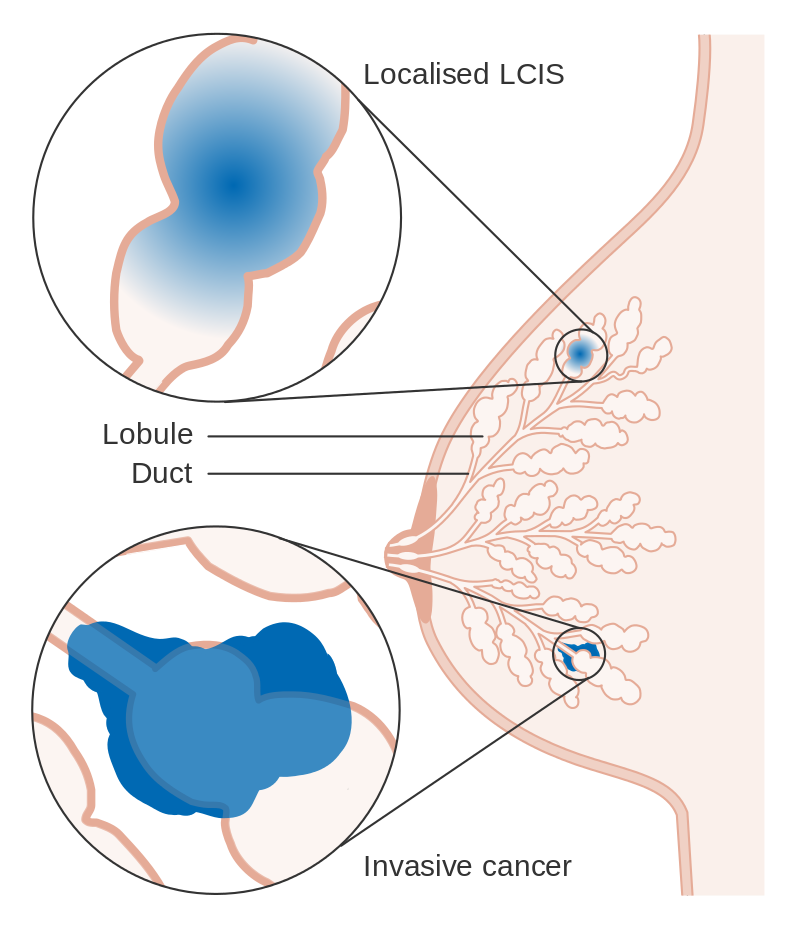 File:Diagram showing lobular carcinoma in situ (LCIS) CRUK 166.svg.png