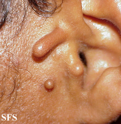 Accessory tragus. Adapted from Dermatology Atlas.[12]