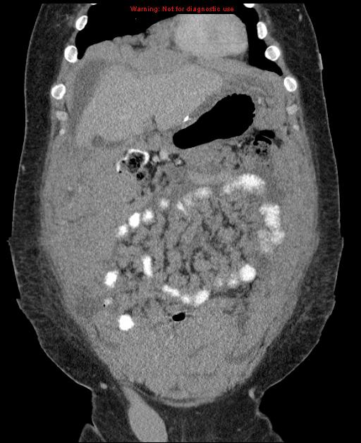 Abdominal CT scan demonstrates an extensive peritoneal disease with ascites.[4]