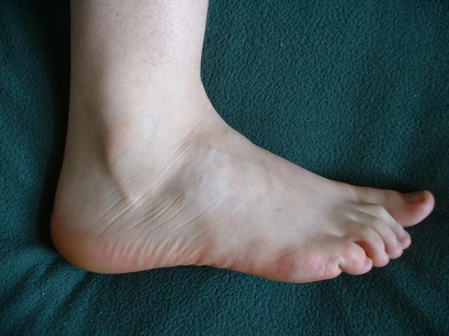 A foot seen from the lateral view.