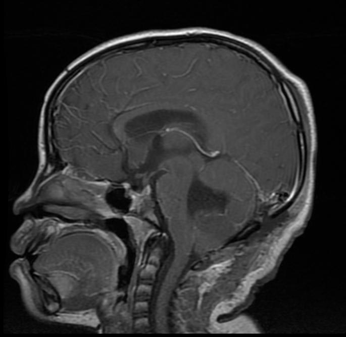 Sagittal MRI section of medulloblastoma[1]
