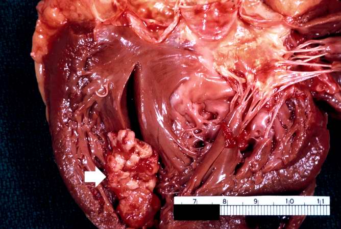 This is a gross photograph of the heart from this case demonstrating the well-formed thrombus (arrow) tightly attached to the myocardium near the apex of the left ventricle.