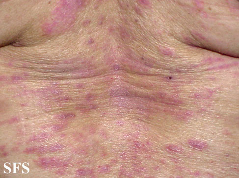 File:Mycosis fungoides 04.jpg