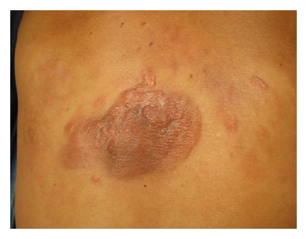 File:Primary cutaneous follicle centre lymphoma image 3.jpg