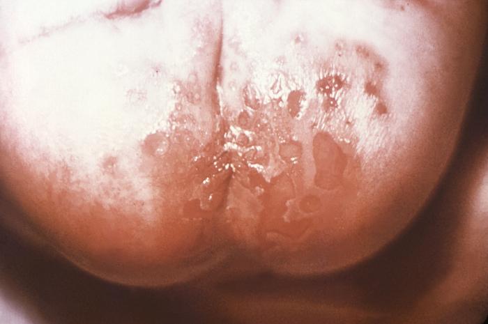 This image depicts the buttocks and perineal region of an infant born with what was diagnosed as congenital syphilis. In this particular case, one will note the presence of eroded, early syphilids. How does syphilis affect a pregnant woman and her baby: The syphilis bacterium can infect the baby of a woman during her pregnancy. Depending on how long a pregnant woman has been infected, she may have a high risk of having a stillbirth (a baby born dead) or of giving birth to a baby who dies shortly after birth. An infected baby may be born without signs or symptoms of disease. However, if not treated immediately, the baby may develop serious problems within a few weeks. Untreated babies may become developmentally delayed, have seizures, or die. Infants born to mothers who have reactive nontreponemal and treponemal test results should be evaluated with a quantitative nontreponemal serologic test (RPR or VDRL) performed on infant serum because umbilical cord blood can become contaminated with maternal blood and could yield a false-positive result. Conducting a treponemal test (i.e., TP-PA or FTA-ABS) on a newborn’s serum is not necessary. No commercially available immunoglobulin (IgM) test can be recommended. All infants born to women who have reactive serologic tests for syphilis should be examined thoroughly for evidence of congenital syphilis (e.g., nonimmune hydrops, jaundice, hepatosplenomegaly, rhinitis, skin rash, and/or pseudoparalysis of an extremity). Pathologic examination of the umbilical cord by using specific fluorescent antitreponemal antibody staining is suggested. Darkfield microscopic examination or DFA staining of suspicious lesions or body fluids (e.g., nasal discharge) also should be performed. Adapted from CDC
