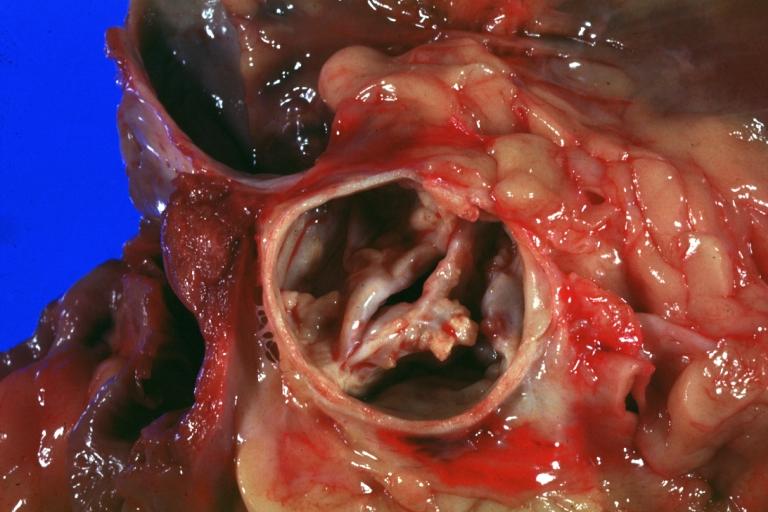 Aortic Stenosis, Bicuspid valve: Gross; image of bicuspid aortic valve, an excellent example