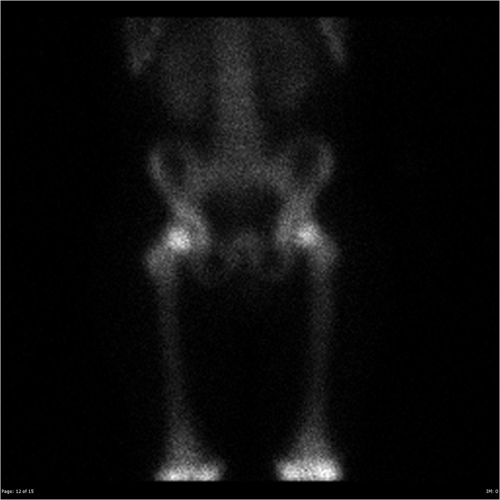 File:Burkitt's lymphoma bone scan 03.jpg