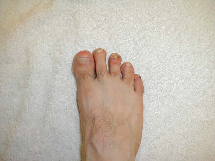 Paronychia: Infection of the skin medial to nail of middle toe. (Courtesy of Charlie Goldberg, M.D.)