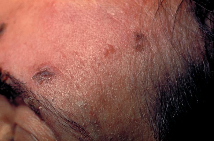 These skin lesions on the forehead of an elderly woman are due to the herpes zoster virus on the 21st day of the illness.