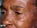 Lupus Erythematosus Chronicus Disseminatus Superficialis. Adapted from Dermatology Atlas.[17]