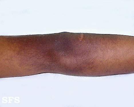 Lichen aureus. Adapted from Dermatology Atlas.[3]