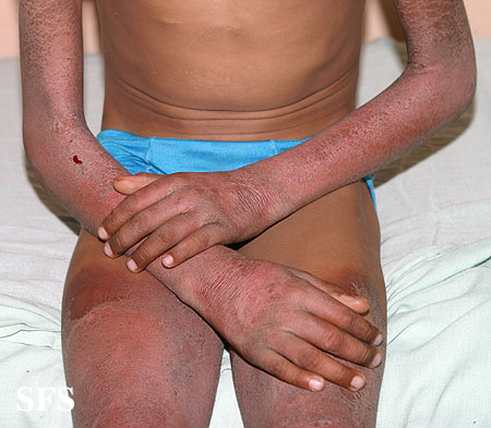Pellagra. With permission from Dermatology Atlas.[5]