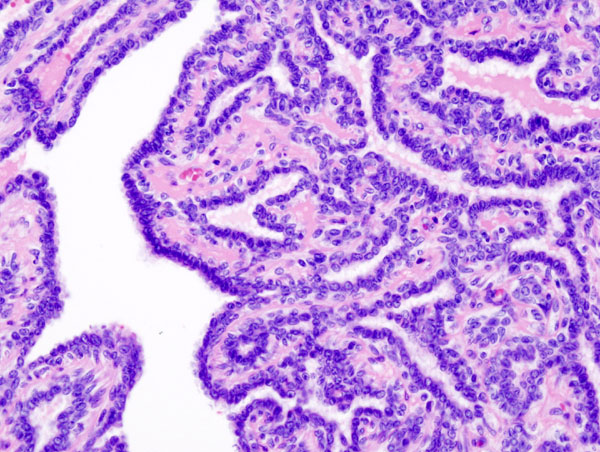 Histopathology of intraductal papilloma of the breast by excisional biopsy. Hematoxylin and eosin stain.
