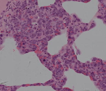 File:Intravascular large B-cell lymphoma pathology image 6.jpg