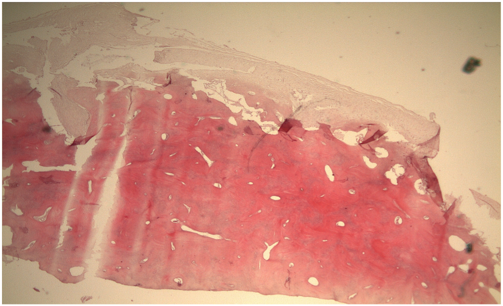 File:Micropathology osteoma.png