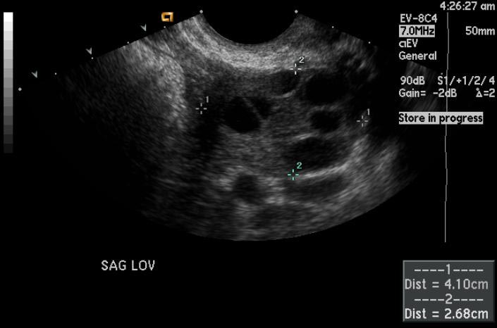 Ovarian-hyperstimulation-001.jpg