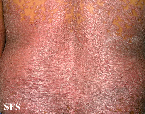 Pityriasis rubra pilaris. Adapted from Dermatology Atlas.[4]