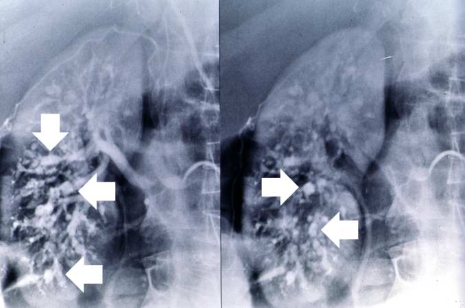 This angiogram of the kidneys demonstrates numerous aneurysmal dilatations in the renal circulation (arrows).