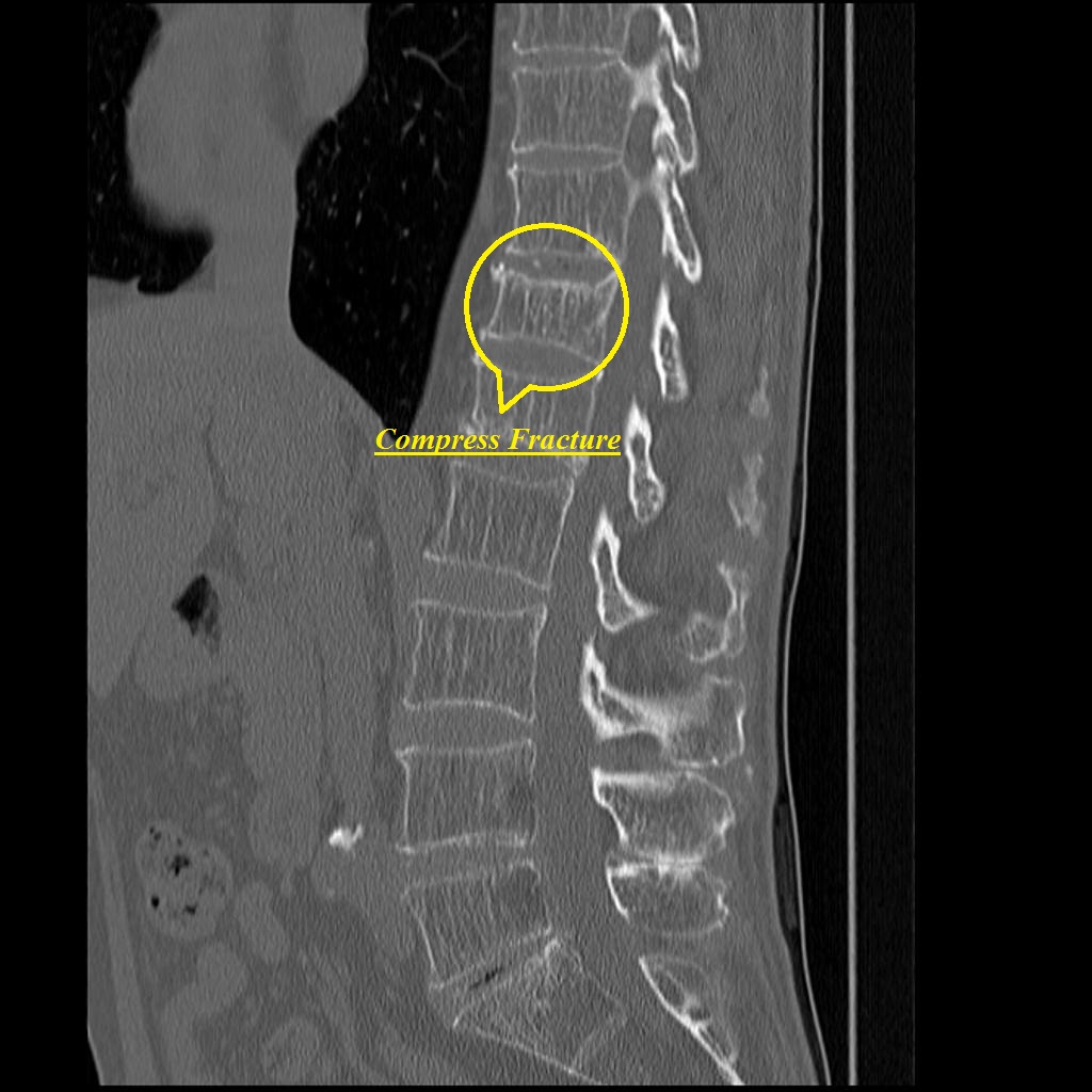 Pathological fracture in T12 and L1 (saggital view) - Case courtesy of Dr Roberto Schubert, Via: Radiopaedia.org[6]
