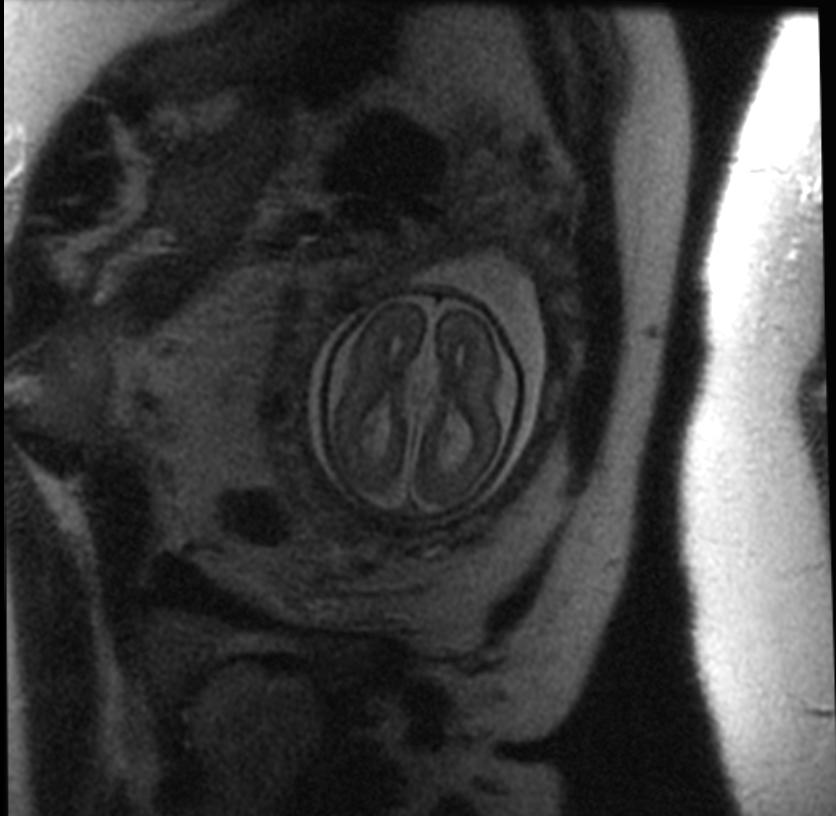File:Agenesis of the corpus callosum fetal MRI 003.jpg