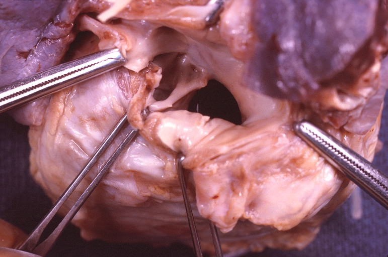 Congenital heart disease, artrio-ventricular (AV) canal
