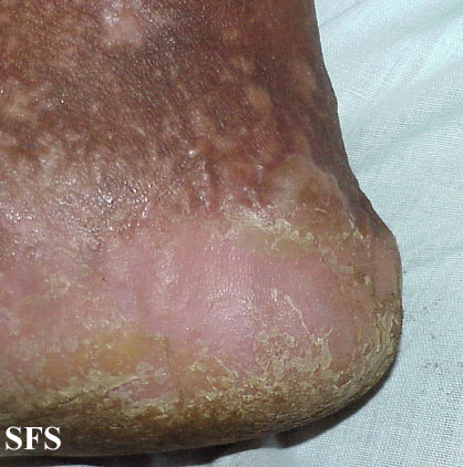 File:Darier's disease34.jpg