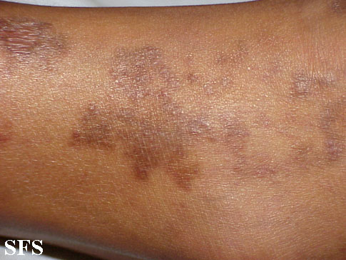 Lichen aureus. Adapted from Dermatology Atlas.[3]