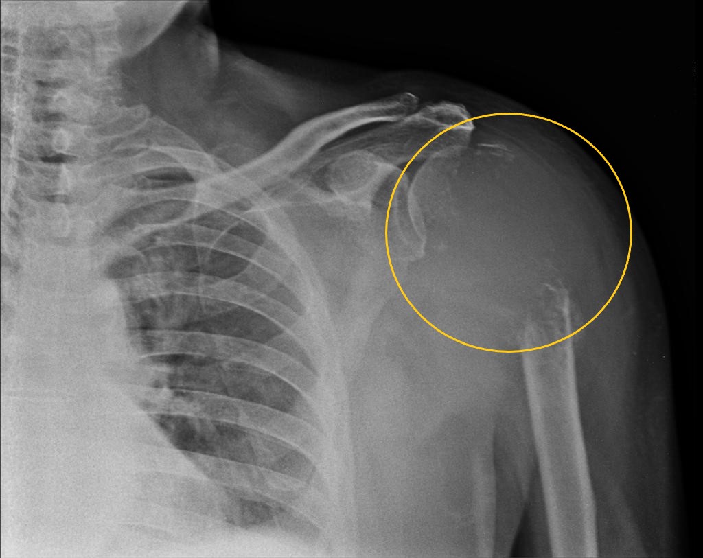 File:Osteolytic Bone Lesion Xray.jpg