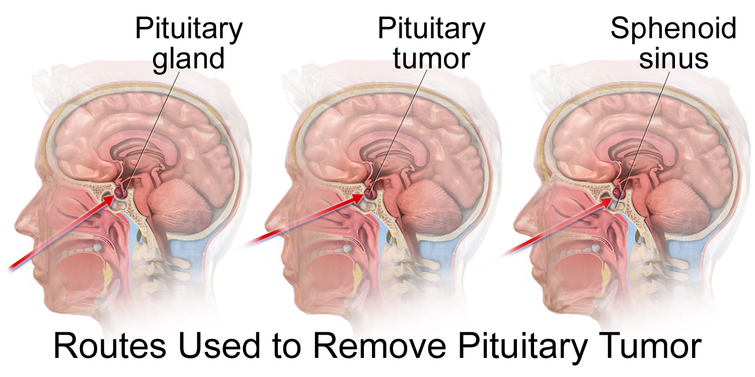 File:Pituitary Tumor Removal.png