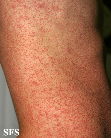 Pityriasis rosea. With permission from Dermatology Atlas.[1]