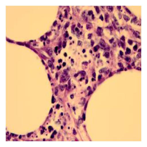 Biopsy of soft tissue : At 100x magnification with oil-immersion biopsy shows area of necrotic debris.[2]