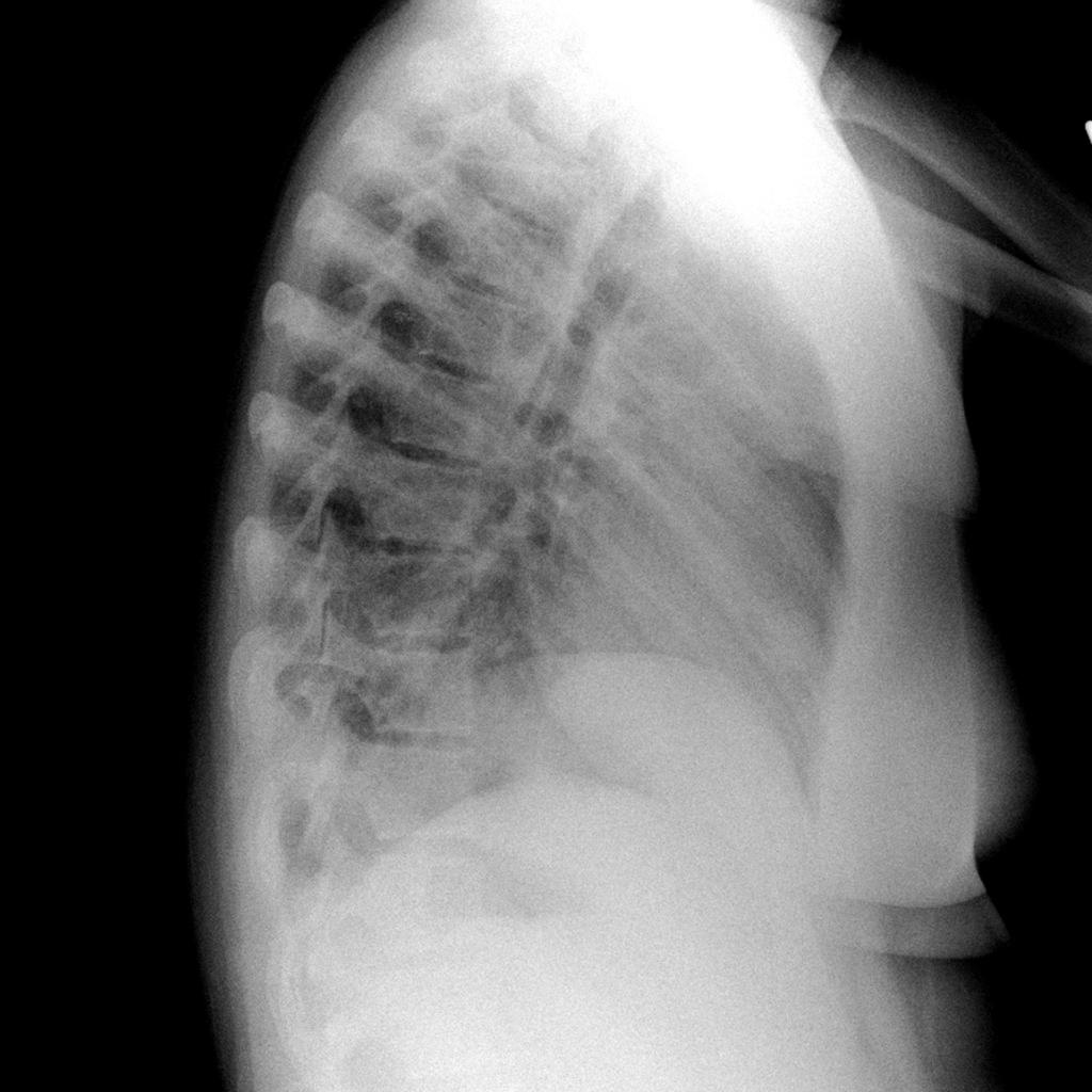 Granulomatosis with polyangiitis- X ray Lateral view showing evidence of consolidation Source:Radiopaedia.org[8]