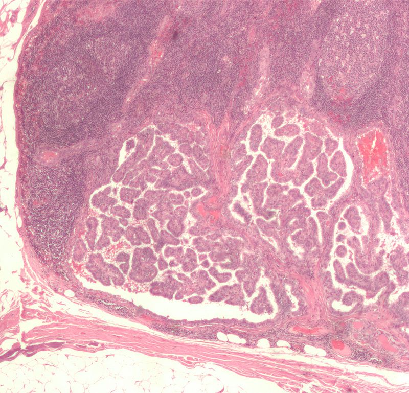 File:-Lymph node with papillary thyroid carcinoma.jpg