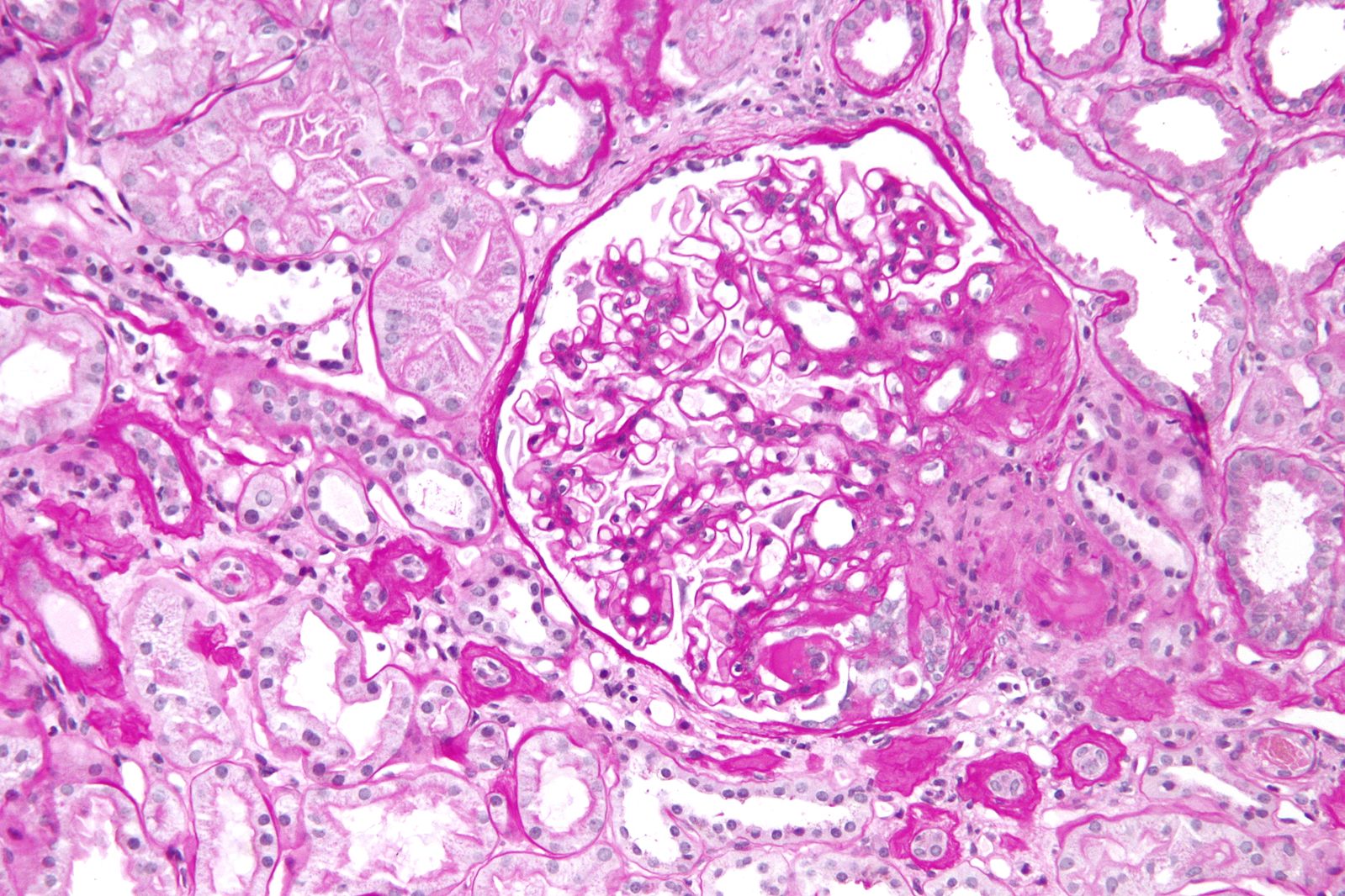 File:1599px-Focal segmental glomerulosclerosis - high mag.jpg