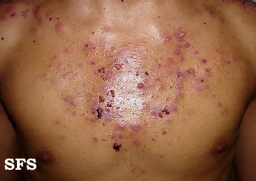 Image description. Adapted from [http://www.atlasdermatologico.com.br/disease.jsf?diseaseId=3