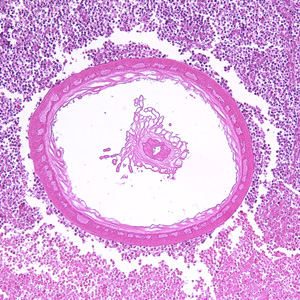 Transverse section through the body wall ofBolbosoma sp. in an intestinal biopsy specimen, stained with H&E. Image taken at 100x magnification. In this image, a portion of the reproductive system is visible within the pseudocoelom. Adapted from CDC
