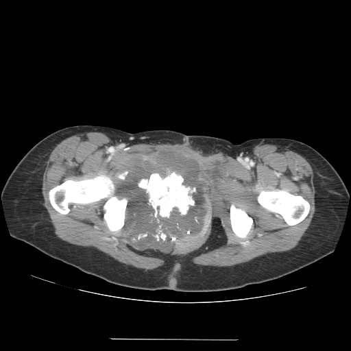 CT images demonstrate a large pelvic chondrosarcoma
