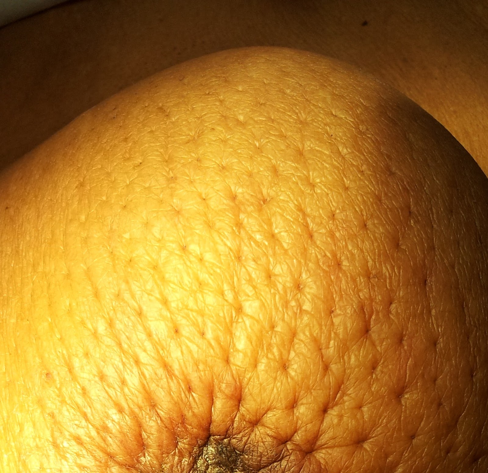 File:Peau d’ orange Appearance in Breast cancer.jpg